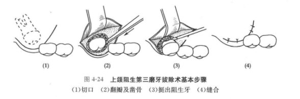 关于口腔的三两件事:智齿