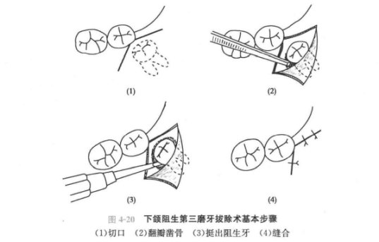关于口腔的三两件事:智齿