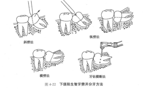 关于口腔的三两件事:智齿