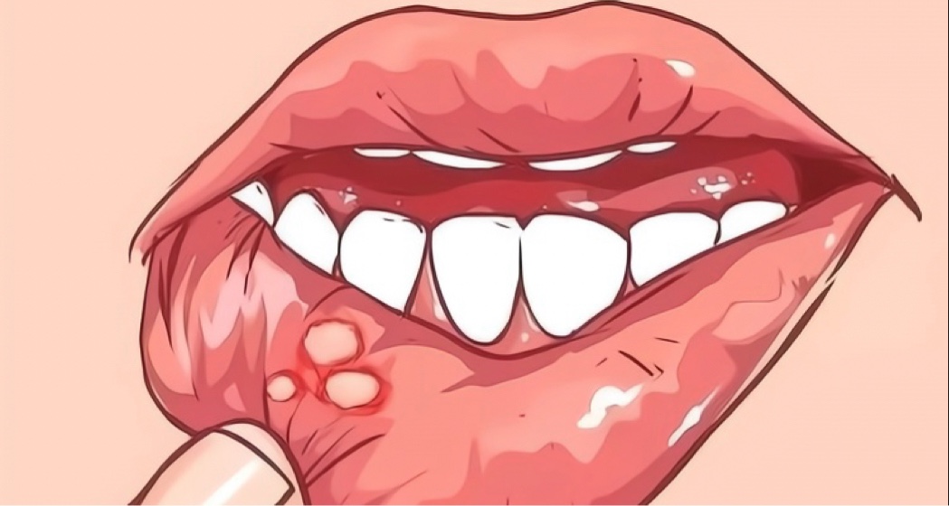 對付口腔潰瘍？看這一篇就夠了！