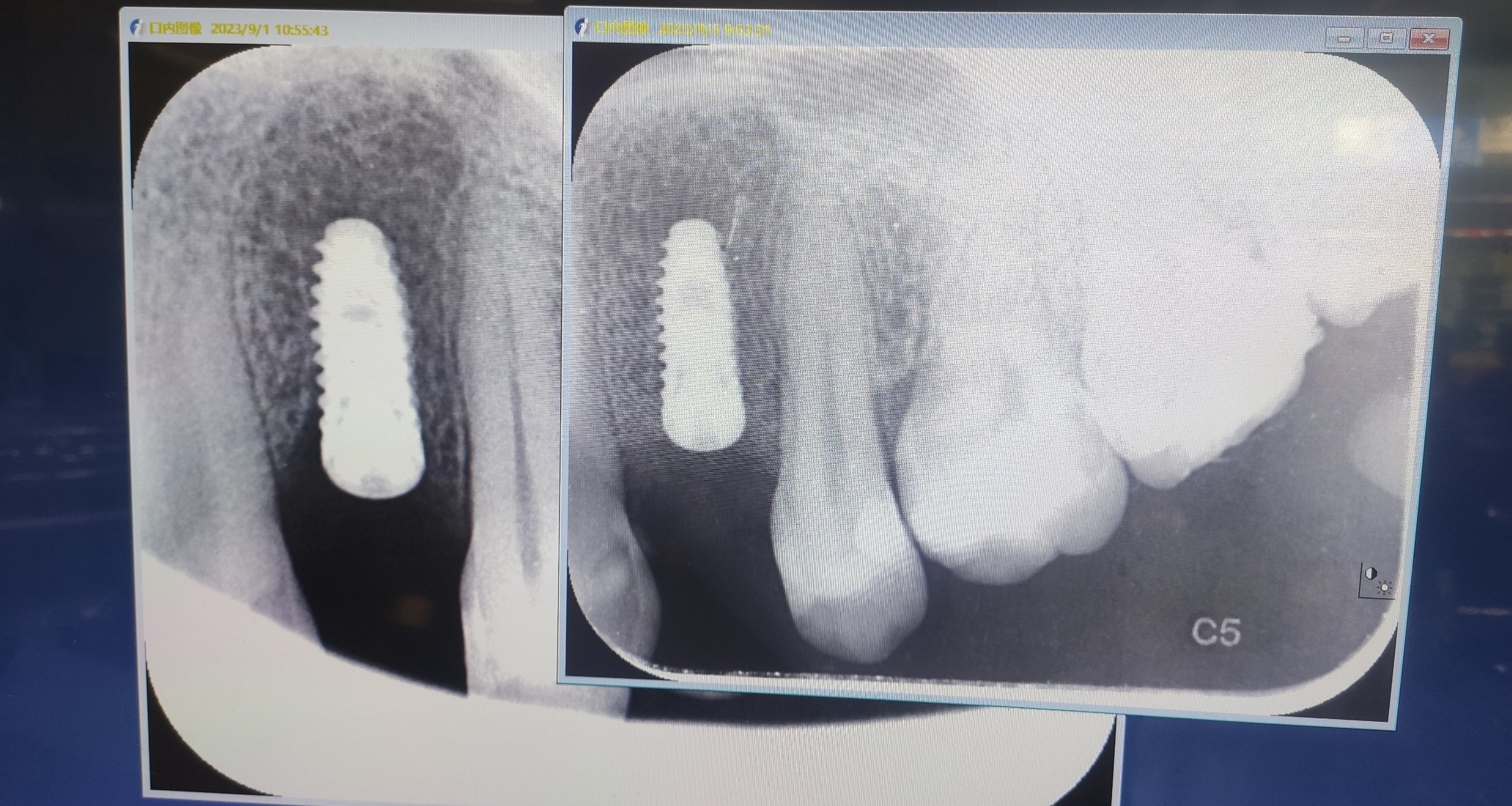痛！痛！痛！牙痛不是病，痛起来要人命！学生党种牙亲身经历