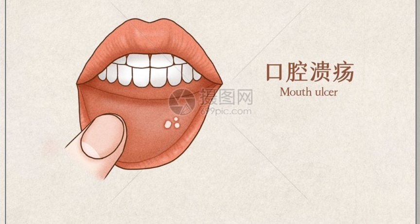 遊戲宅必備口腔潰瘍治療平價藥品