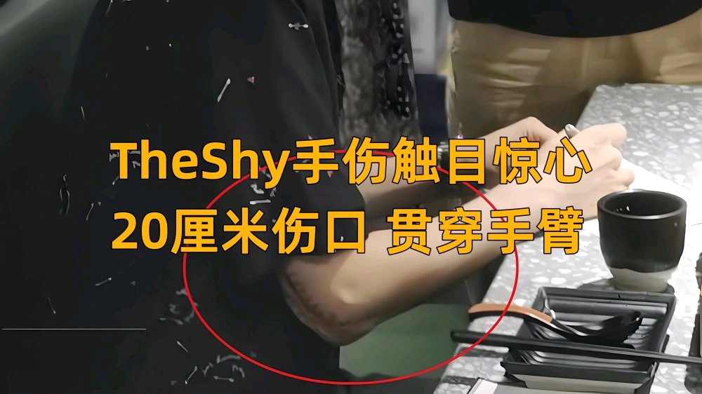 【英雄聯盟】TheShy的手傷有多嚴重？直播透露免兵役，胳膊20釐米傷口-第5張