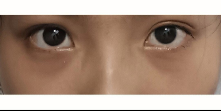 【百科知识】黑眼圈的改善方法-第2张