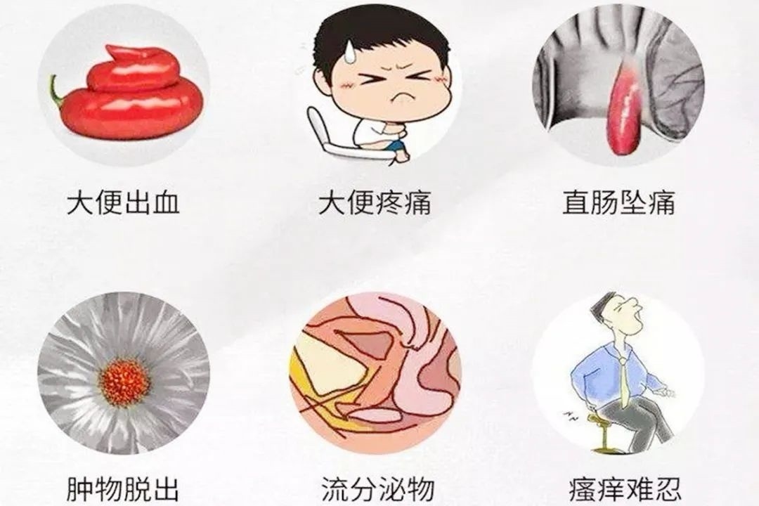 “十男九痔”？養成好習慣，科學預防，不做有“痔”之士-第1張