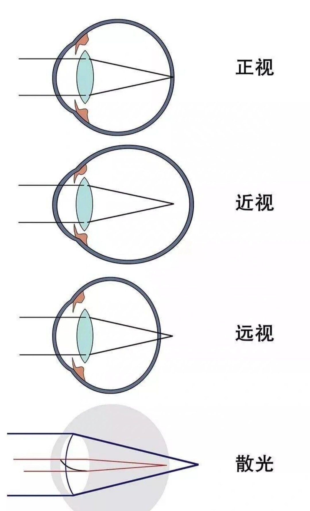 容易被人忽视的远视-第1张