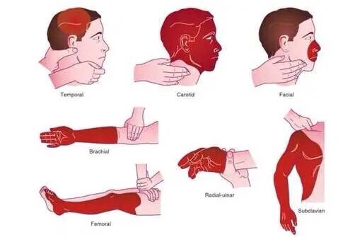 大学生自救指南：常见的动脉位置和止血急救方法-第16张