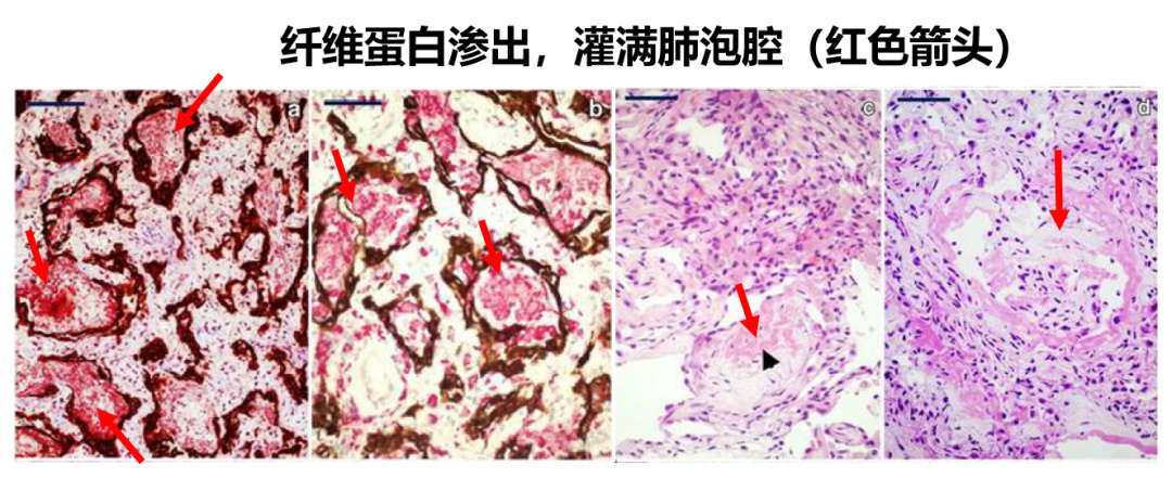 新冠病毒损伤肺部全过程揭秘&如何正确使用抗生素和激素？