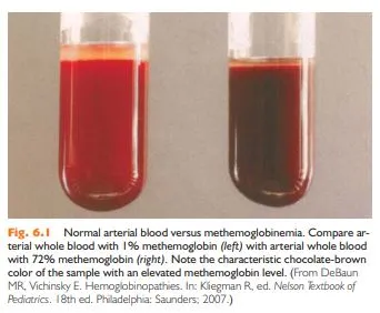 Dapson and Methemoglobinemia | Pediatric Focus