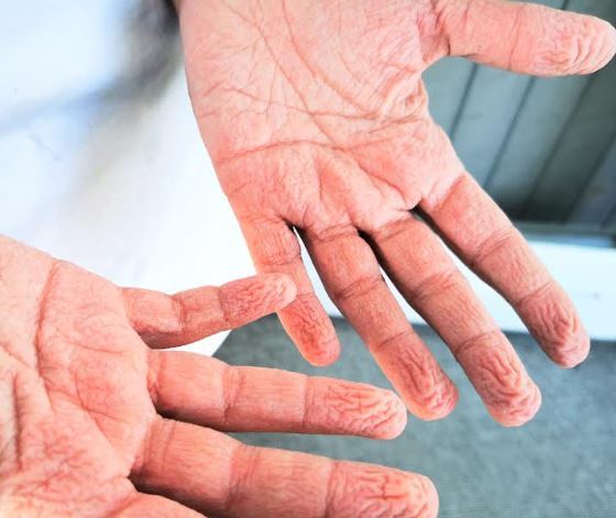Why do our fingers wrinkle in water?