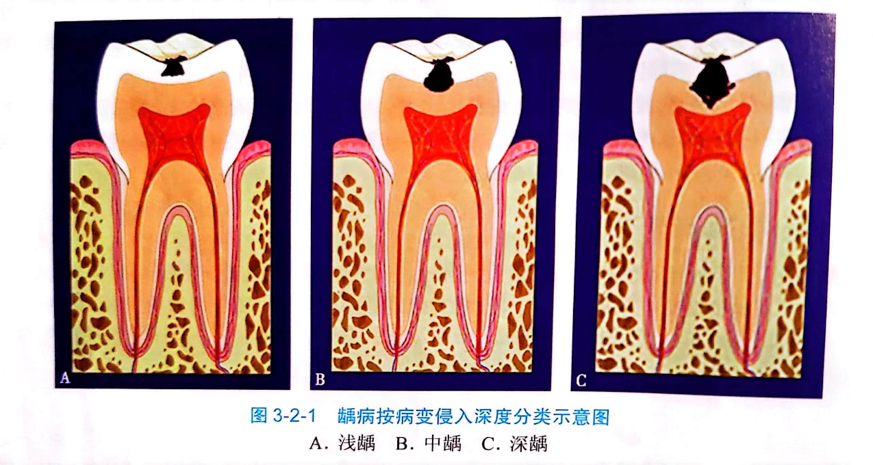 关于口腔的三两件事：龋病