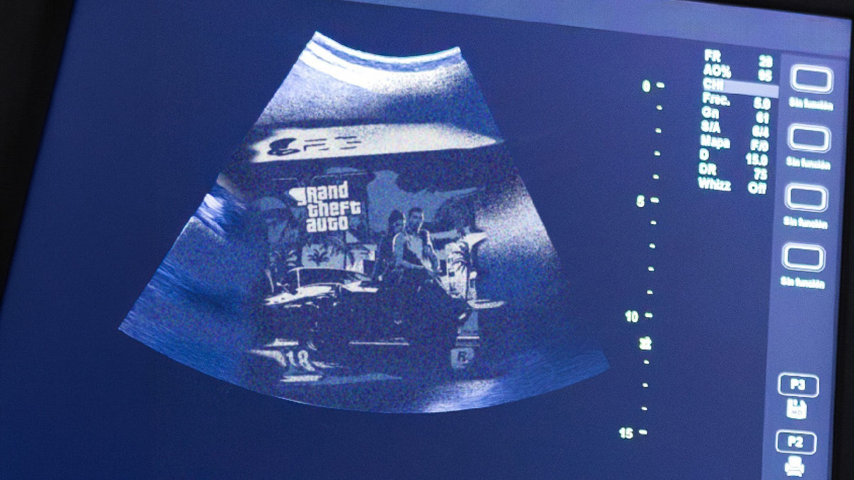Grand theft auto ultrasound
